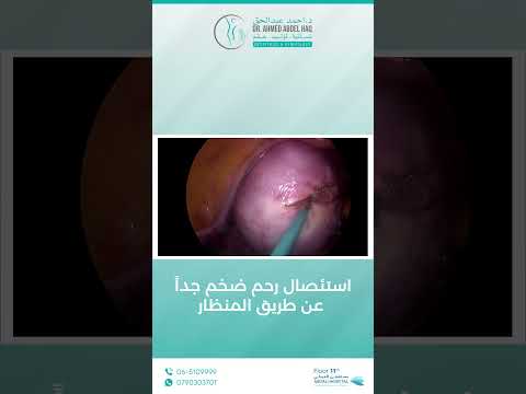 استئصال رحم ضخم جدا عن طريق المنظار