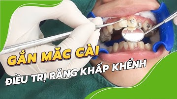 Gắn mắc cài niềng răng điều trị hàm răng lệch lạc, khấp khểnh, chen chúc