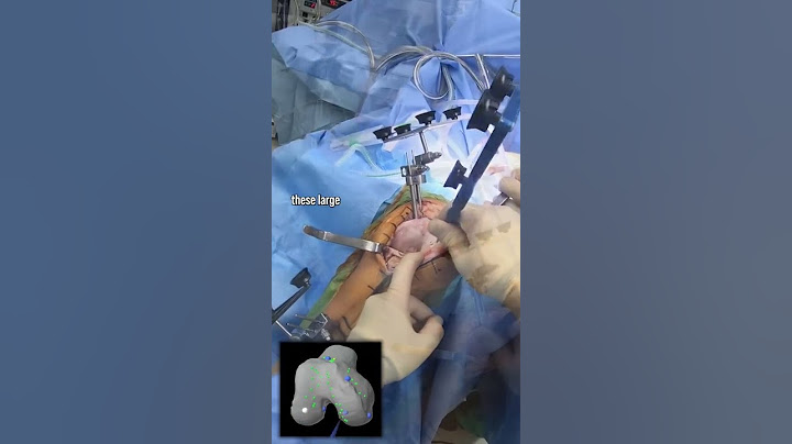 👀Robotic Knee Surgery #shorts