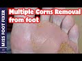Multiple Corns Removal ! Satisfying Deep Corn Removal Full Treatment By Miss Foot Fixer