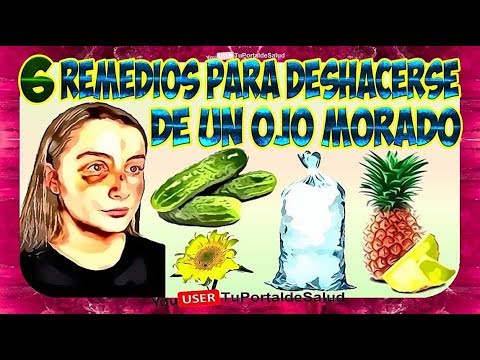 Video: 3 formas de deshacerse de un ojo morado