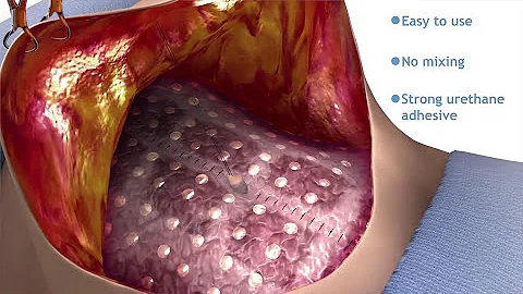 TissuGlu and a Drainless Tummy Tuck