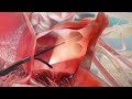 Step-by-Step: How 4D ICE supports PFA and LAAC procedures