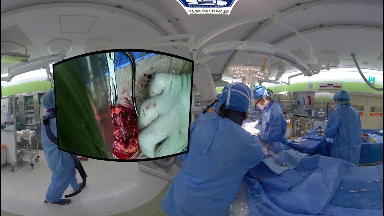 211021 Thrombectomy Endarterectomy With Patch Angioplasty Stent 211021-thrombectomy-endarterectomy-with-patch-angioplasty-stent
