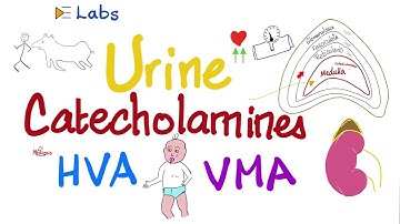 Catecholamines (Epinephrine, No-Epinephrine, Dopamine), Metanephrines, HVA, VMA | Pheochromocytoma