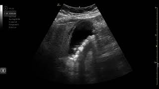 PoCUS Gall Bladder - Acute Cholecystitis