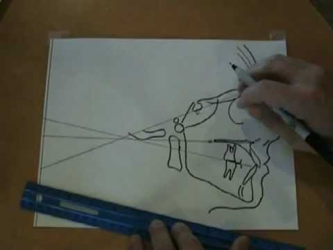 dr yosh jefferson demonstrates his cephalometric analysis part 1 2 cephalometric analysis