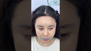 Những ai nên cấy tóc sợi dài? | CẤY TÓC BLACK HAIR