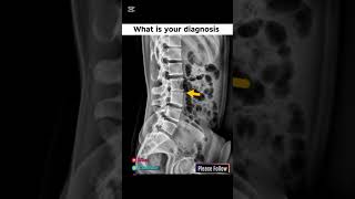 x ray lumbosacral spine lateral view#xray #diagnosis #spine