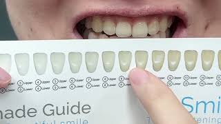 วิธีใช้ ชุดฟอกสีฟันแบบเครื่อง LED ใช้งานง่าย 15 นาทีเสร็จ ฟันขาวสะอาดปลอดภัย