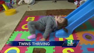 Conjoined twins from Antelope thrive after surgery
