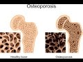 Osteoporosis