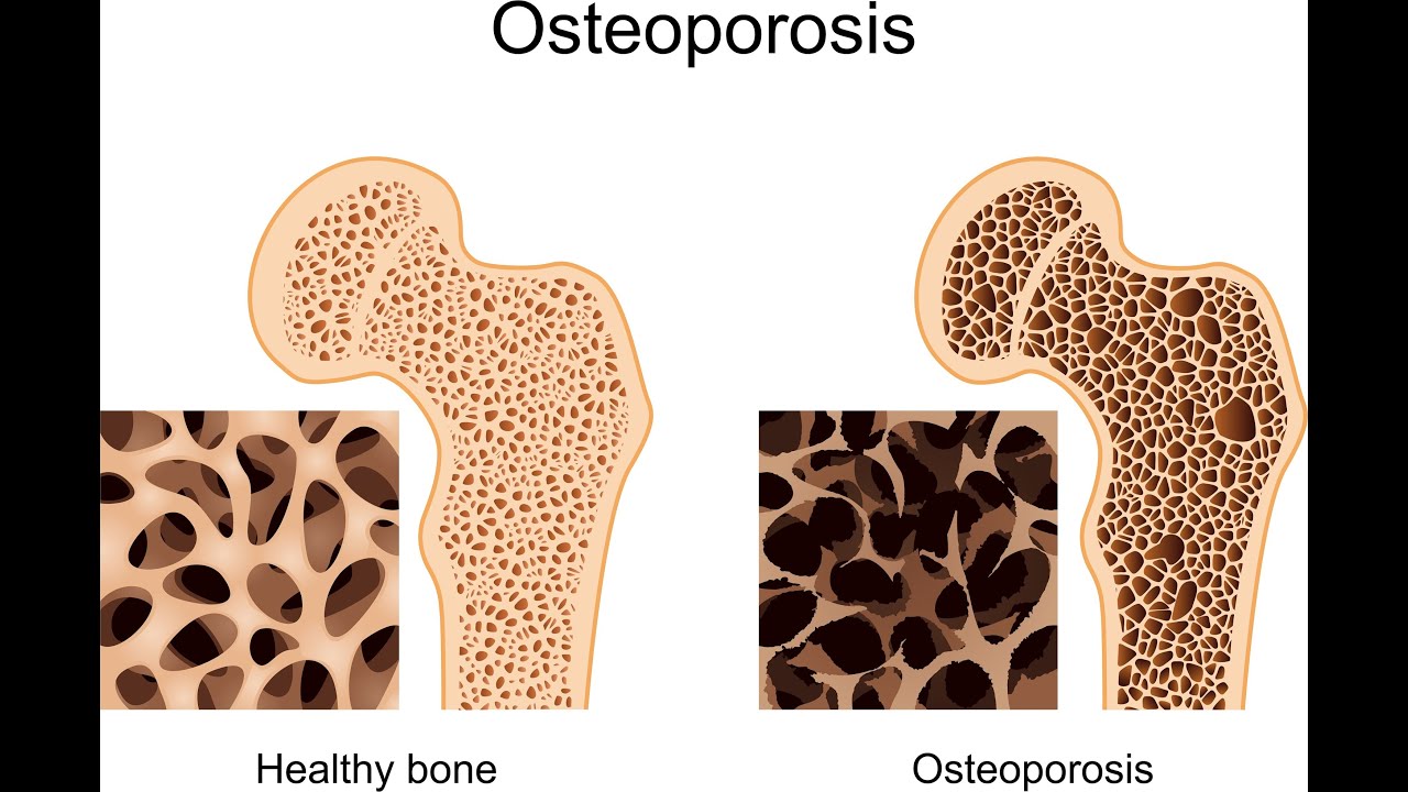 PENGERTIAN DAN PENCEGAHAN OSTEOPOROSIS – RS Kasih Ibu 