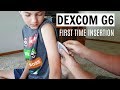 Dexcom G6 First Impressions