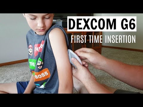 Dexcom G6 First Impressions