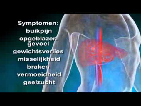 Video: Ethanolextract Van Ophiorrhiza Pumila Onderdrukt De Proliferatie En Migratie Van Leverkankercellen