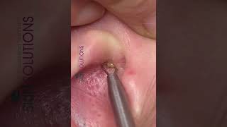 Ear Blackhead Removal