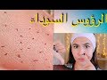 الرؤوس السوداء انزلقت من وجهي!! حقيقة ام خيال؟+حالة وجهي بعد الحلاقة (update)