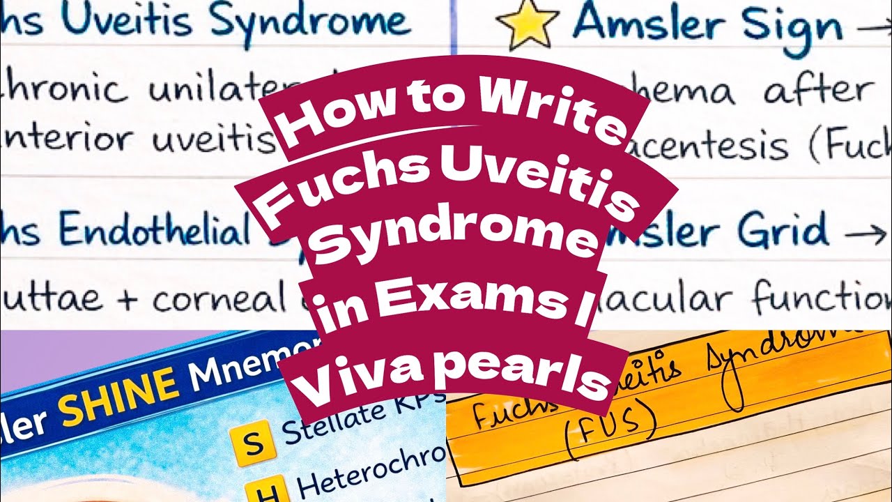 Quick Revision of Fuchs Uveitis Syndrome | How to WRITE in Exams & VIVA pearls | PG Ophthalmology 
