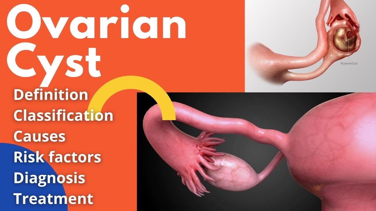 Ovarian cyst YouTube