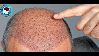 تكلفة زراعة الشعر في المغرب 2019