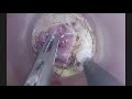 Restorative proctocolectomy  ipaa for right colonic cancer on fap combined laparoscopytatme
