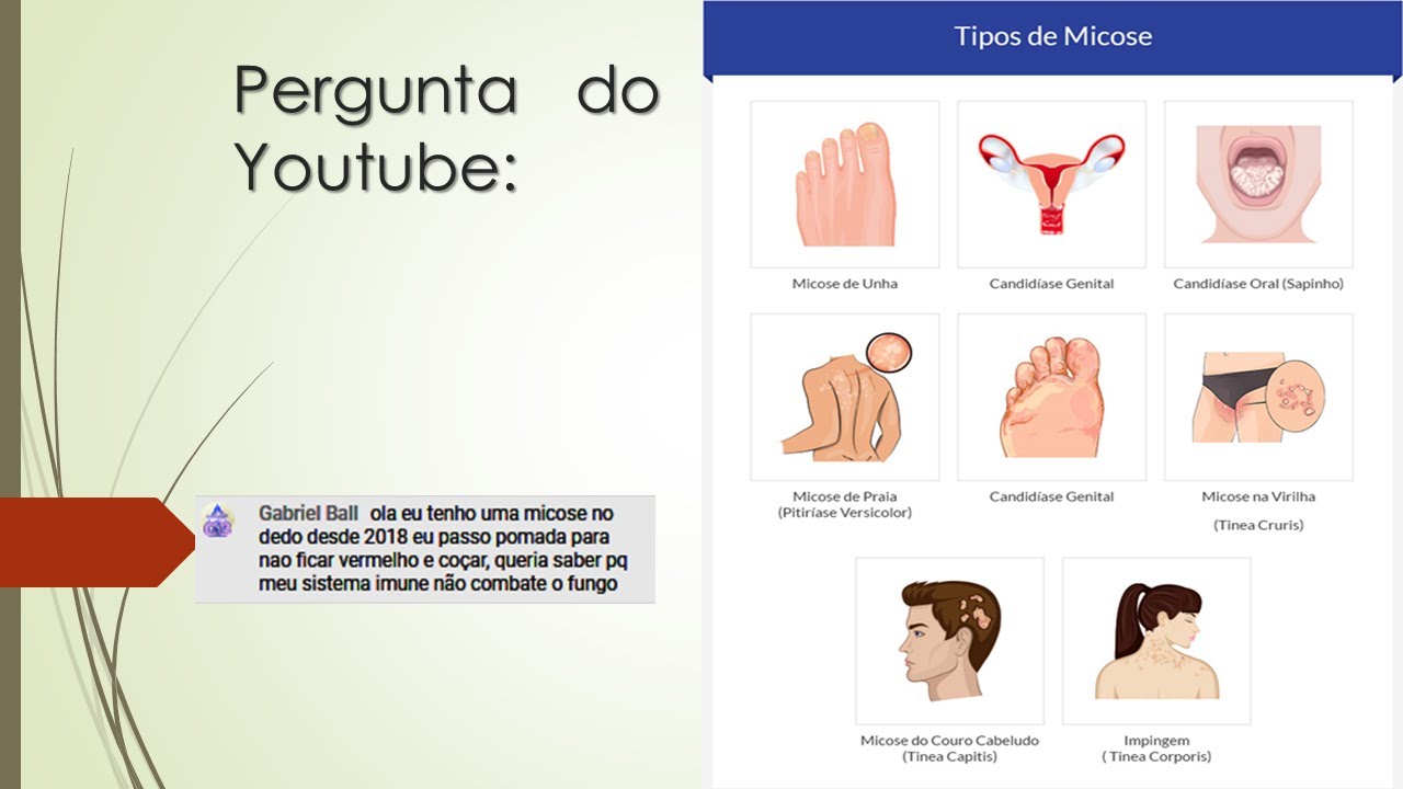 Tenho micose no dedo, passo pomada e não melhora