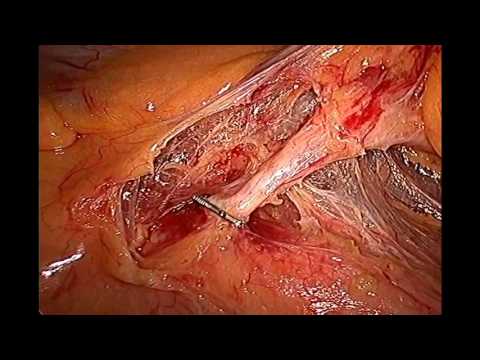 Laparoscopic Sigmoid Resection About Half Hour