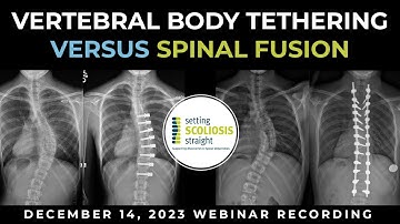 2023 Vertebral Body Tethering Vs Spinal Fusion Webinar  |  Power Over Scoliosis