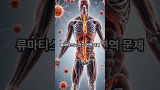 무릎이 보내는 경고 신호, 퇴행성관절염
