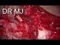 LEFT REVISION CANAL WALL DOWN MASTOIDECTOMY WITH BOOMERANG OSSICULOPLASTY AND CAVITY OBLITERATION