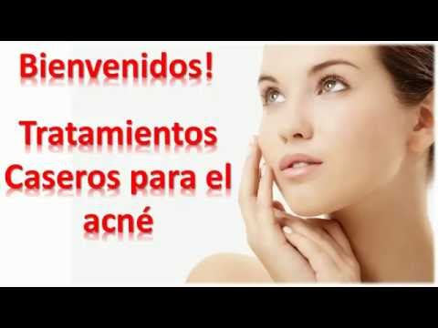 Tratamientos Caseros Para El Acne Juvenil | Remedios caseros para el acne