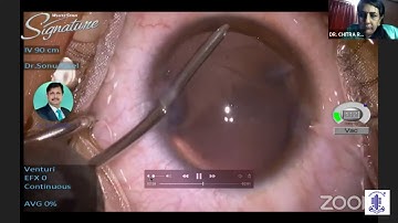 AIOS ARC - Cataract Surgery in Complexities - A Learning-Dr.Sonu Gole