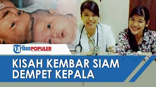 🔴 Kisah Yuliana-Yuliani, Kembar Siam Dempet Kepala yang Berhasil Operasi di Indonesia Tahun 1987