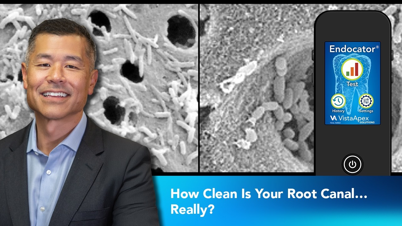 How Clean Is Your Root Canal… Really? | Dentist 2 Dentist