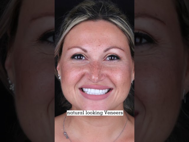 A happy patient from UK on her Hollywood Smile Makeover experience at Queens Medical Center