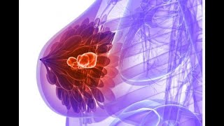 Breast Cancer View Under A Microscope