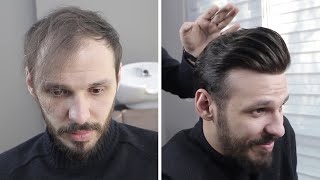 PROTEZ SAÇ NEDİR NASIL YAPILIR - Hair Replacement