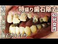 前歯も奥歯も歯石だらけ⁉︎😱特盛り歯石除去🦷✨Both front and back teeth are full of tartar ⁉︎😱 Special tartar removal ✨