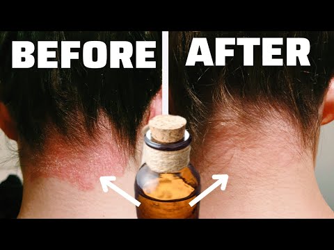 Video: Zašto je depilacija štetna za vašu kožu?