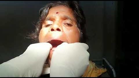 Temporomandibular joint dislocation reduction