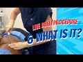 “Live” Avéli Procedure &amp; What is it?