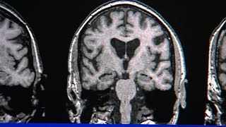 SA researchers studying how drug treatment could be used to decrease effects of aging mind