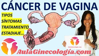 🦀 CÁNCER DE VAGINA 🦀 : TIPOS, SÍNTOMAS, ESTADIAJE, TRATAMIENTO... - Ginecología y Obstetricia -