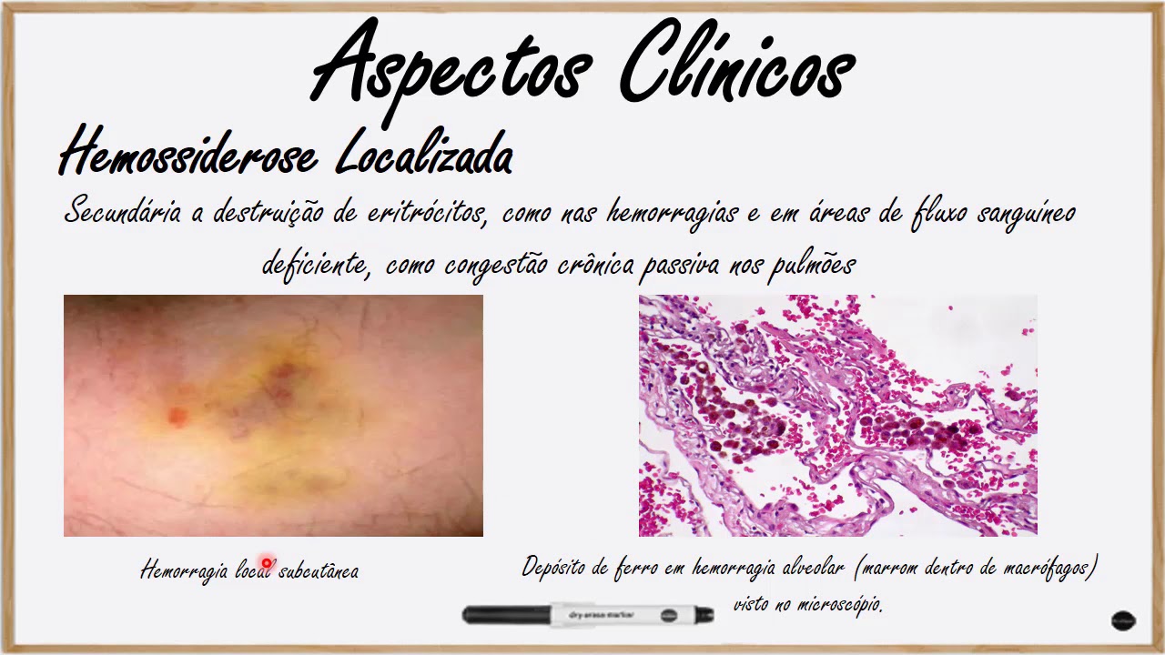 Patologia Geral Pigmentação Hemossiderina YouTube Patologia Geral Pigmentação Hemossiderina YouTube