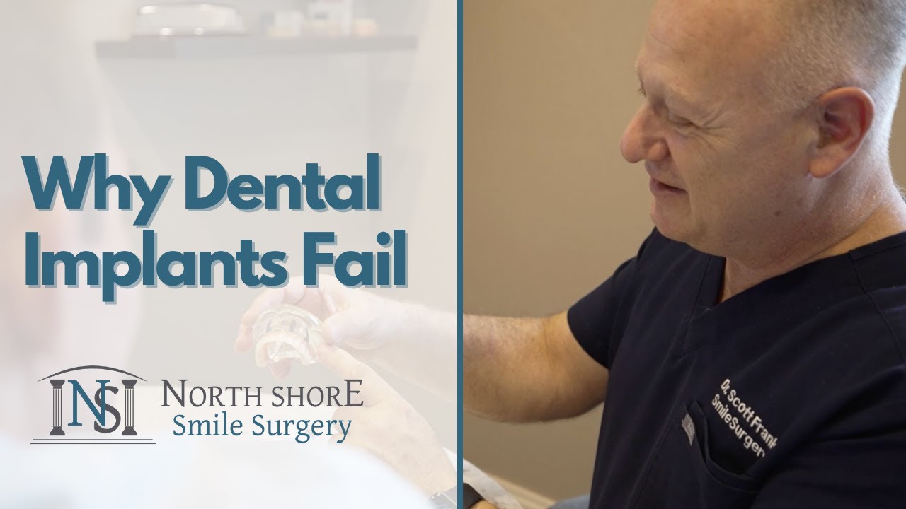The Top Reasons Why Dental Implants Fail!