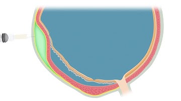 Animated Illustration of the Suprachoroidal Viscopexy Procedure