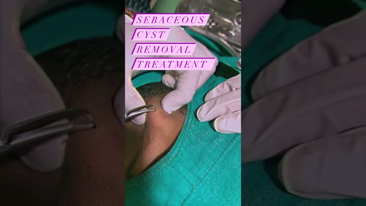Cyst/sebaceous cyst removal/cyst removal/laser treatment/dermatologist surat/dr mahesh patel