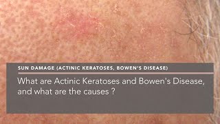 What Are Actinic Keratoses And Bowens Disease, And What Are The Causes?