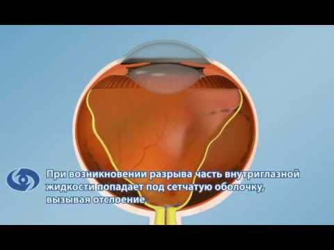 Лечение отслойки сетчатки: витрэктомия